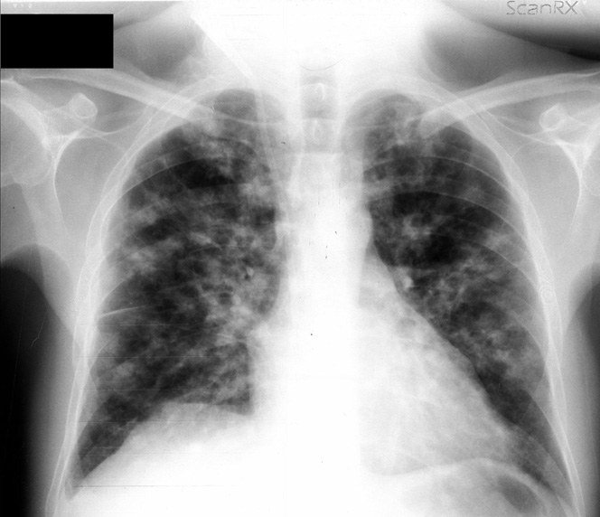 Tratamento preventivo de tuberculose quadruplicou em 4 anos